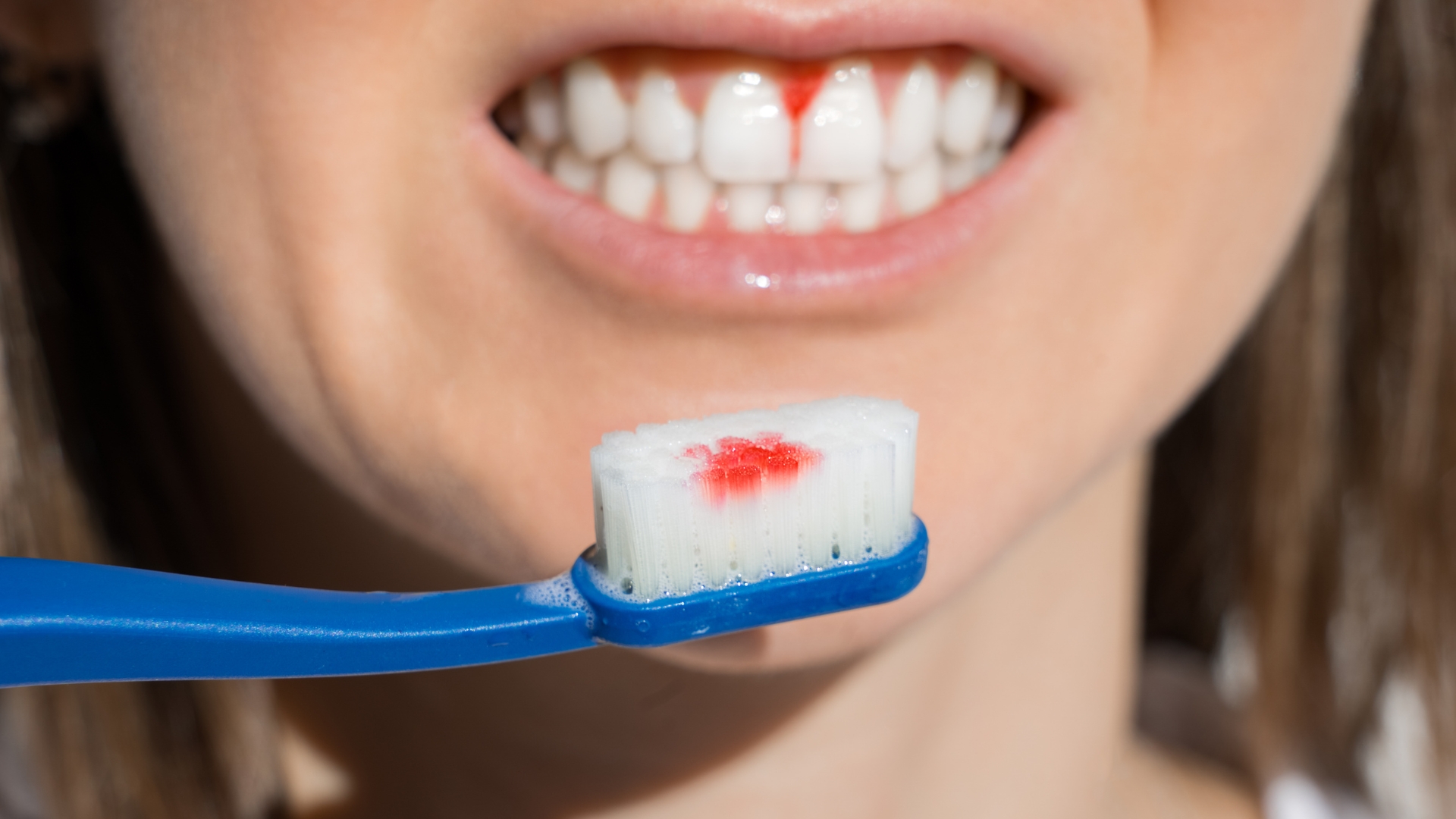 Причини за кървене на венците и как да го лекуваме? - Дентална клиника B-dent